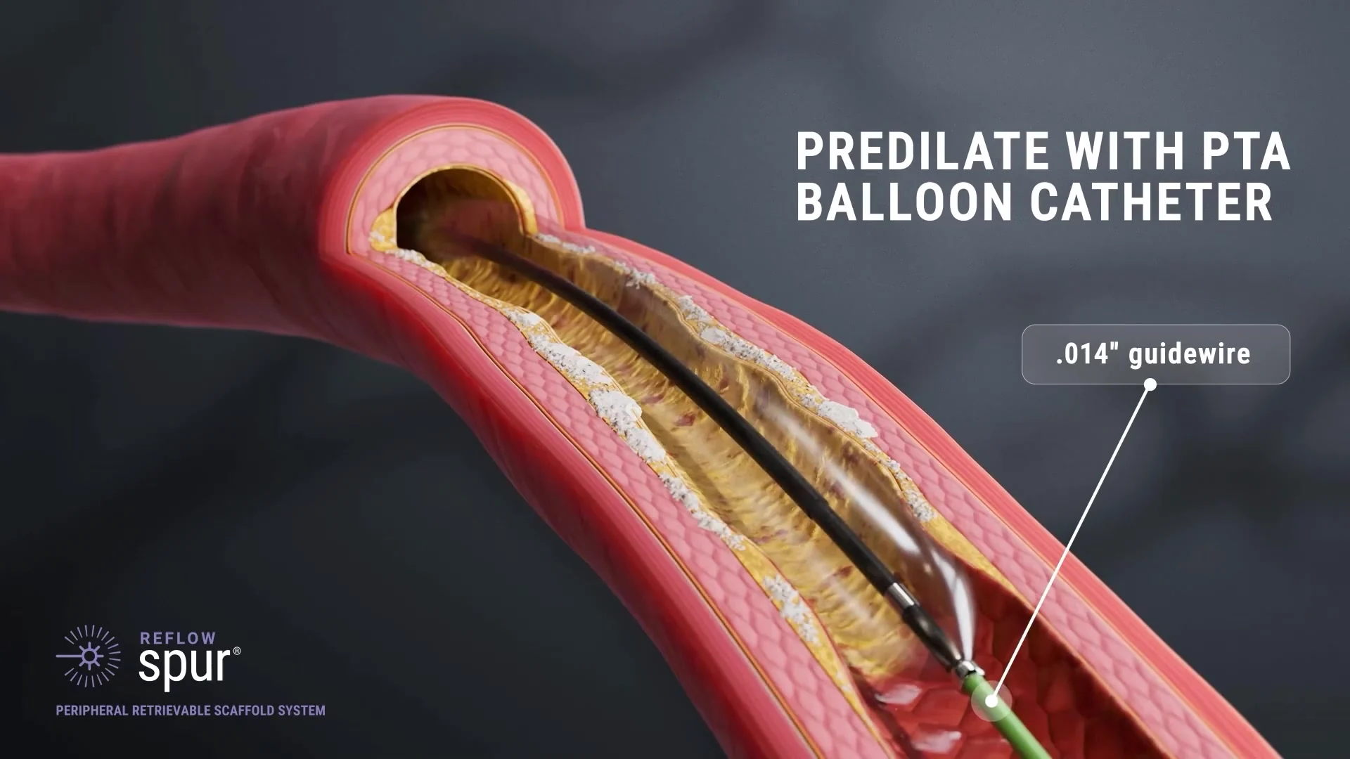 Cutaway vascular scene showing guidewire and balloon catheter context