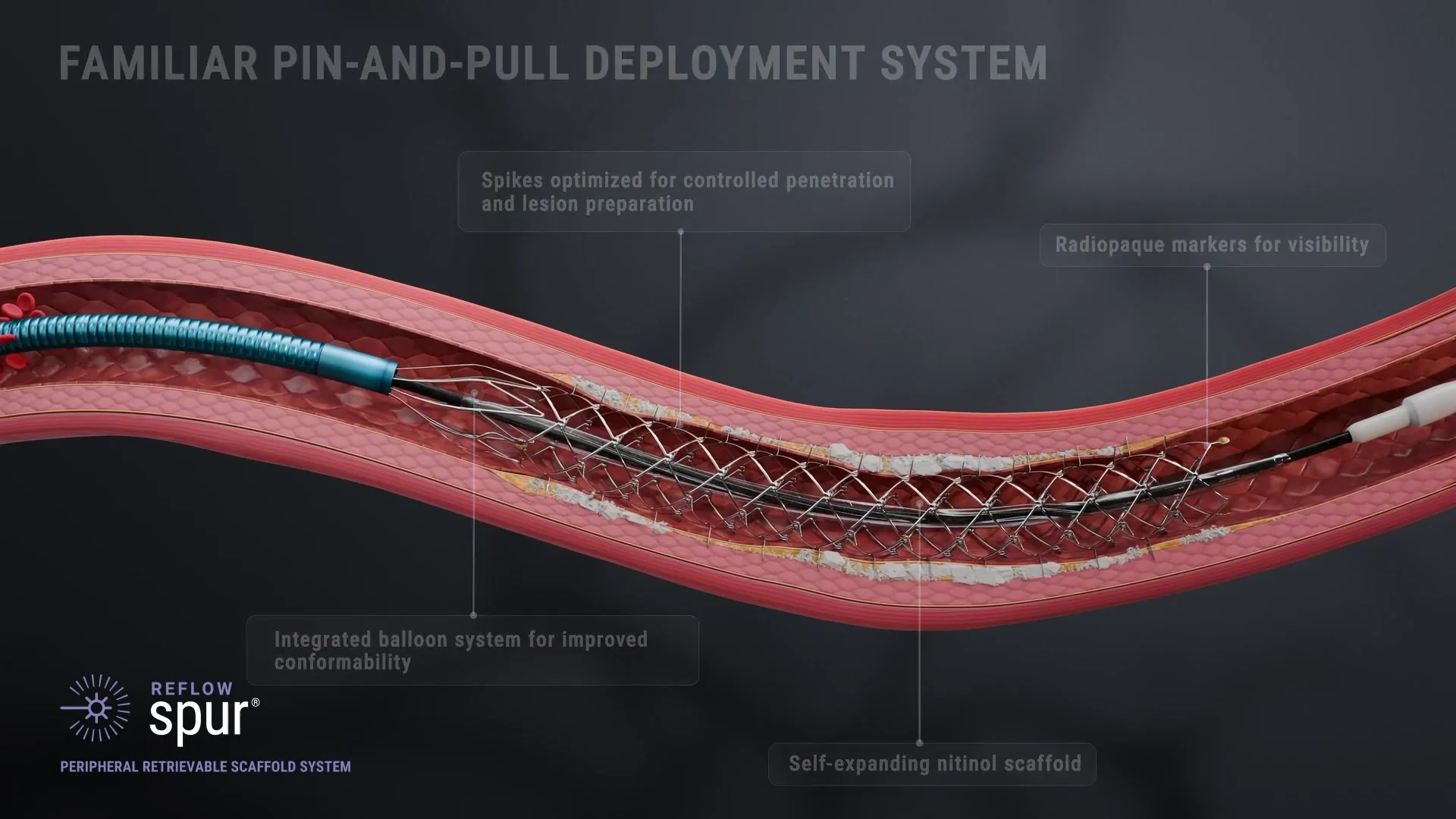 Spur scaffold deployed inside a cutaway vessel visualization
