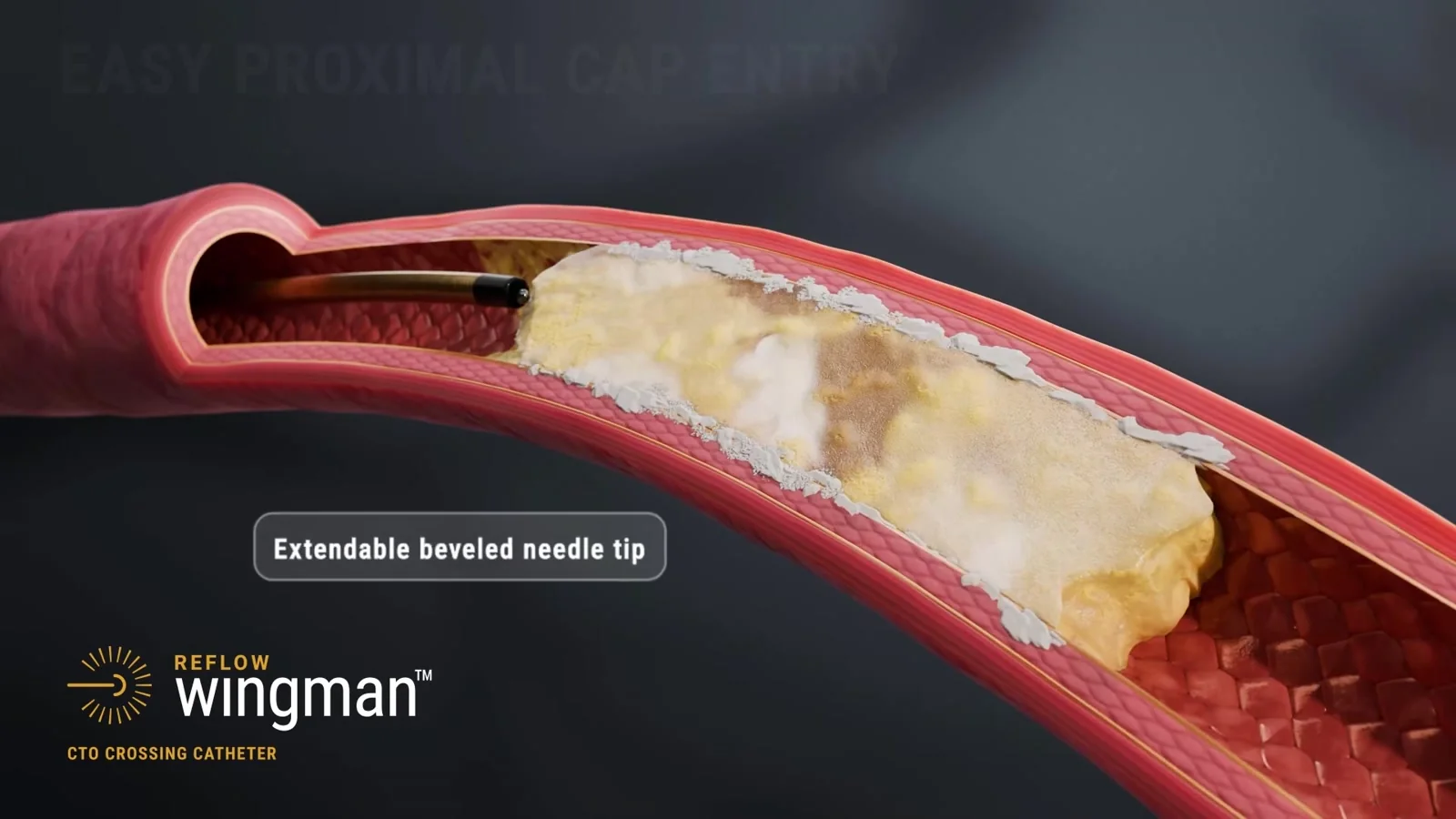 Closeup of Wingman catheter distal tip visualization