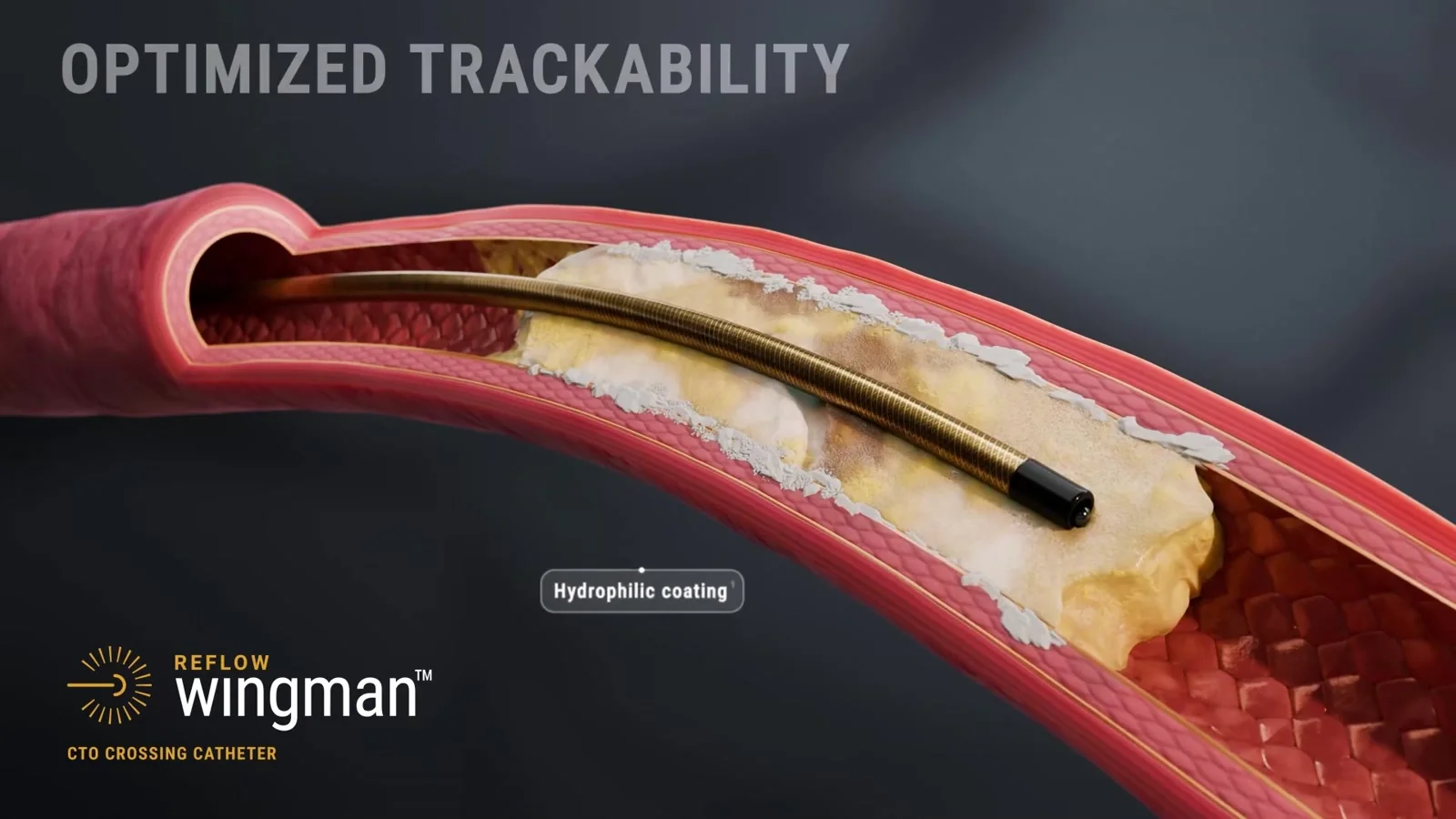 Wingman catheter shown in vascular lesion crossing context
